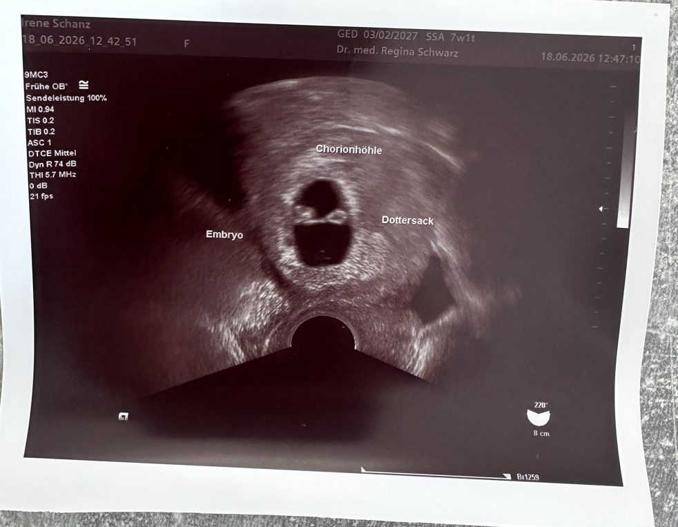 Ultraschall 18.06.2026 mit Beschriftung: Chorionhöhle, Dottersack, Embryo