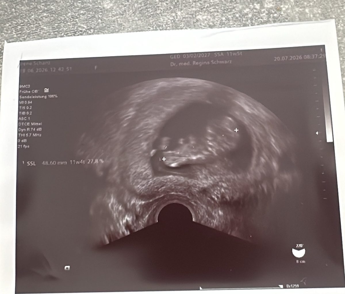 Ultraschall 20.07.2026, SSL-Messung 48,60 mm