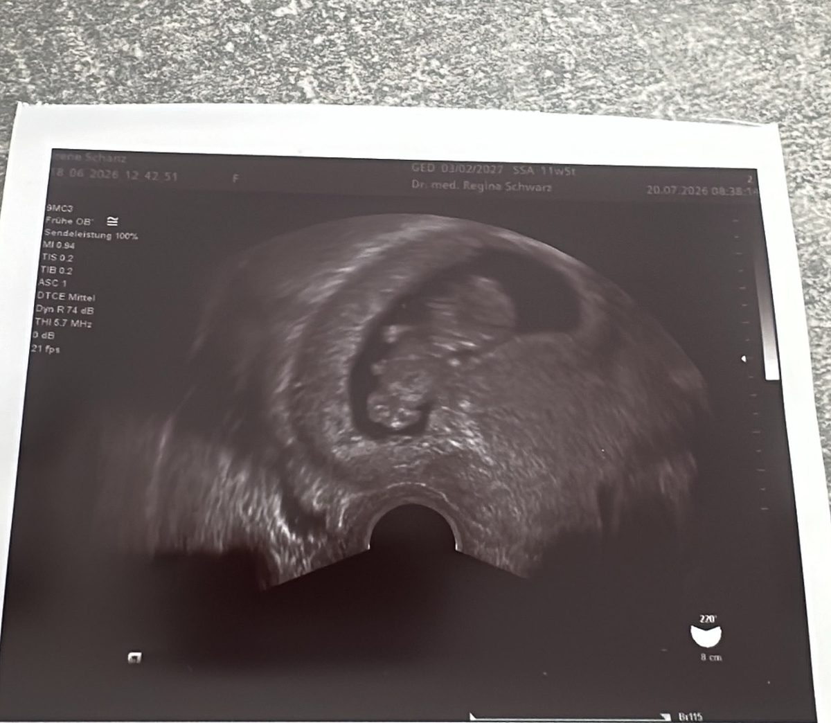Ultraschall 20.07.2026, Profil des Babys